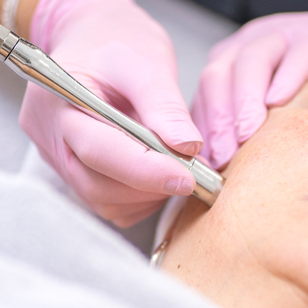 Diamant-Microdermabrasion