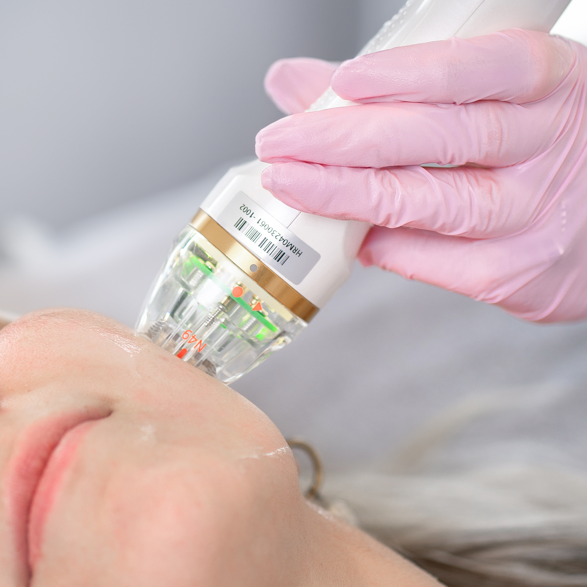 Microneedling